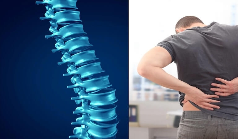 Omurga Kanalında Darlık (Dar Kanal): Yaşla Birlikte Artan Sessiz Tehdit